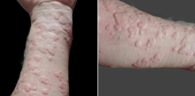 Centro - La #Urticaria es una afección cutánea común que se caracteriza ...