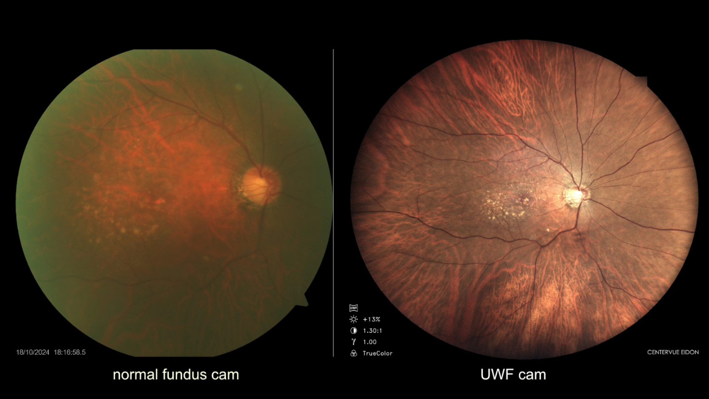 Evershine - Eidon (uwf) ultra wide field fundus camera can capture ...
