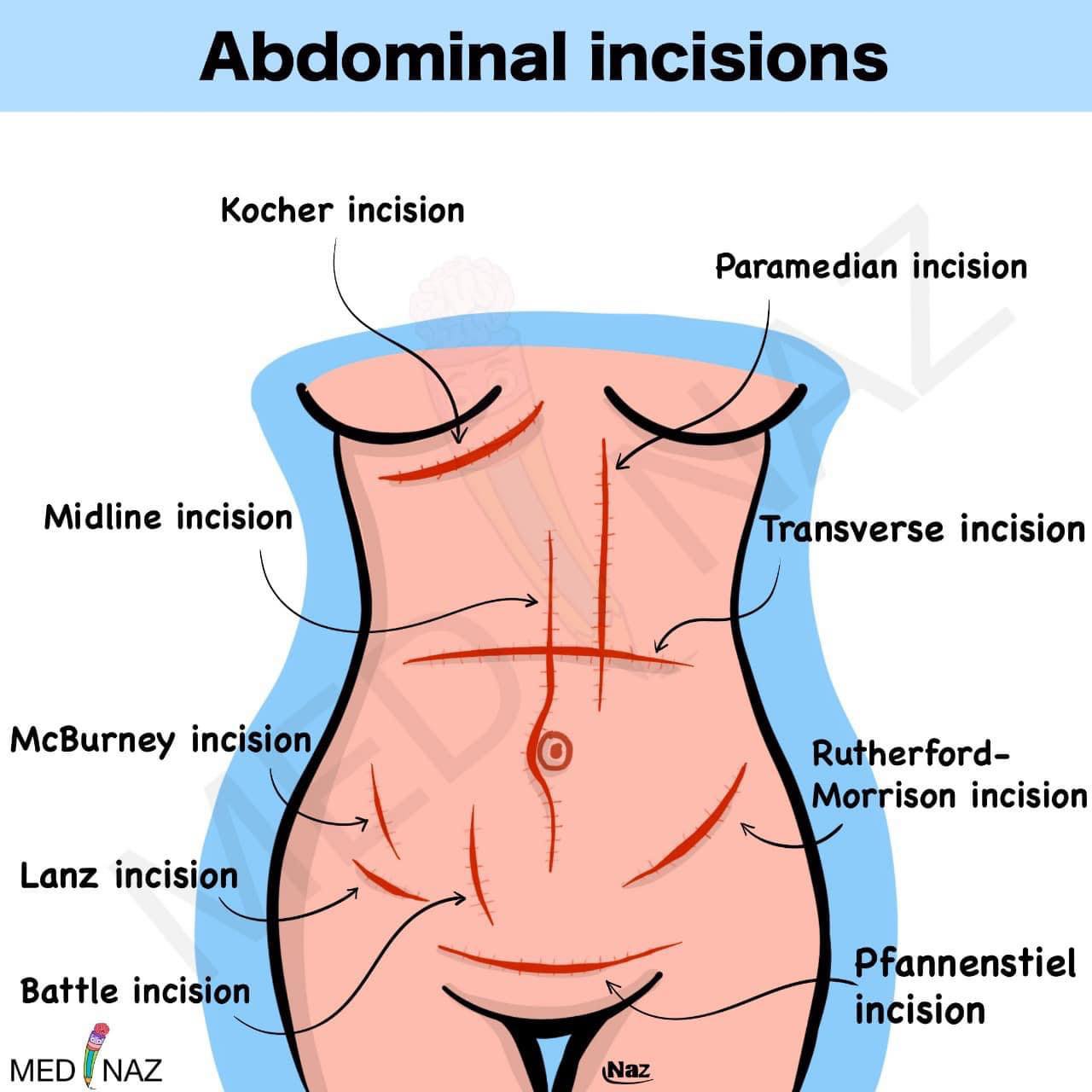 Medinaz Academy - Abdominal incisions to remember | Facebook