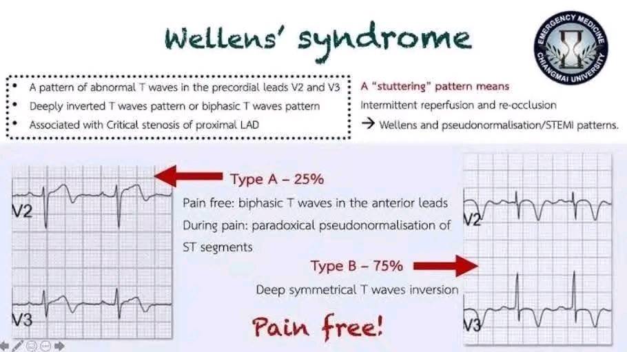 - Wellen … impending STEMI - Cardiology online | Facebook