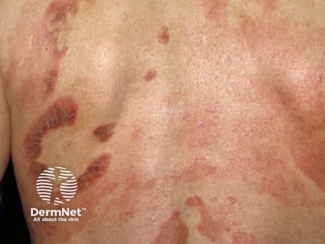 DermNet - Mycosis fungoides is the commonest type of... | Facebook