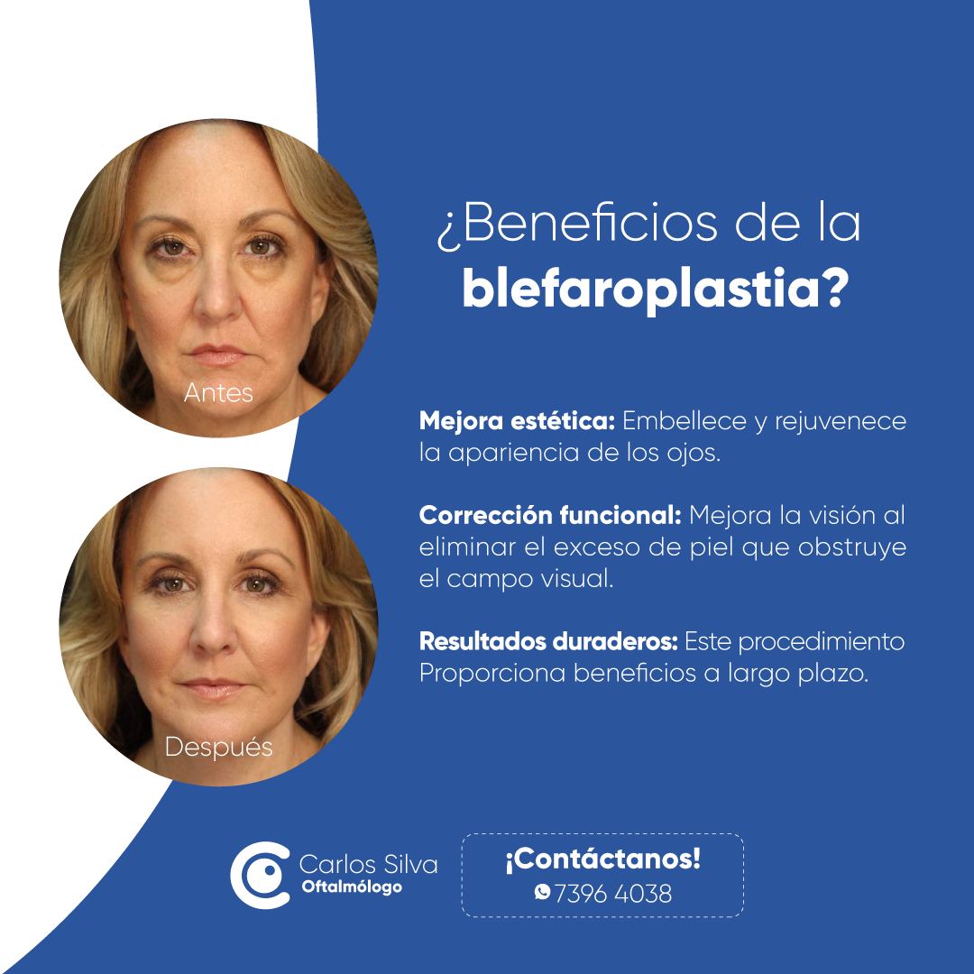 Dr. - La blefaroplastia no solo mejora la apariencia de tus ojos, sino ...