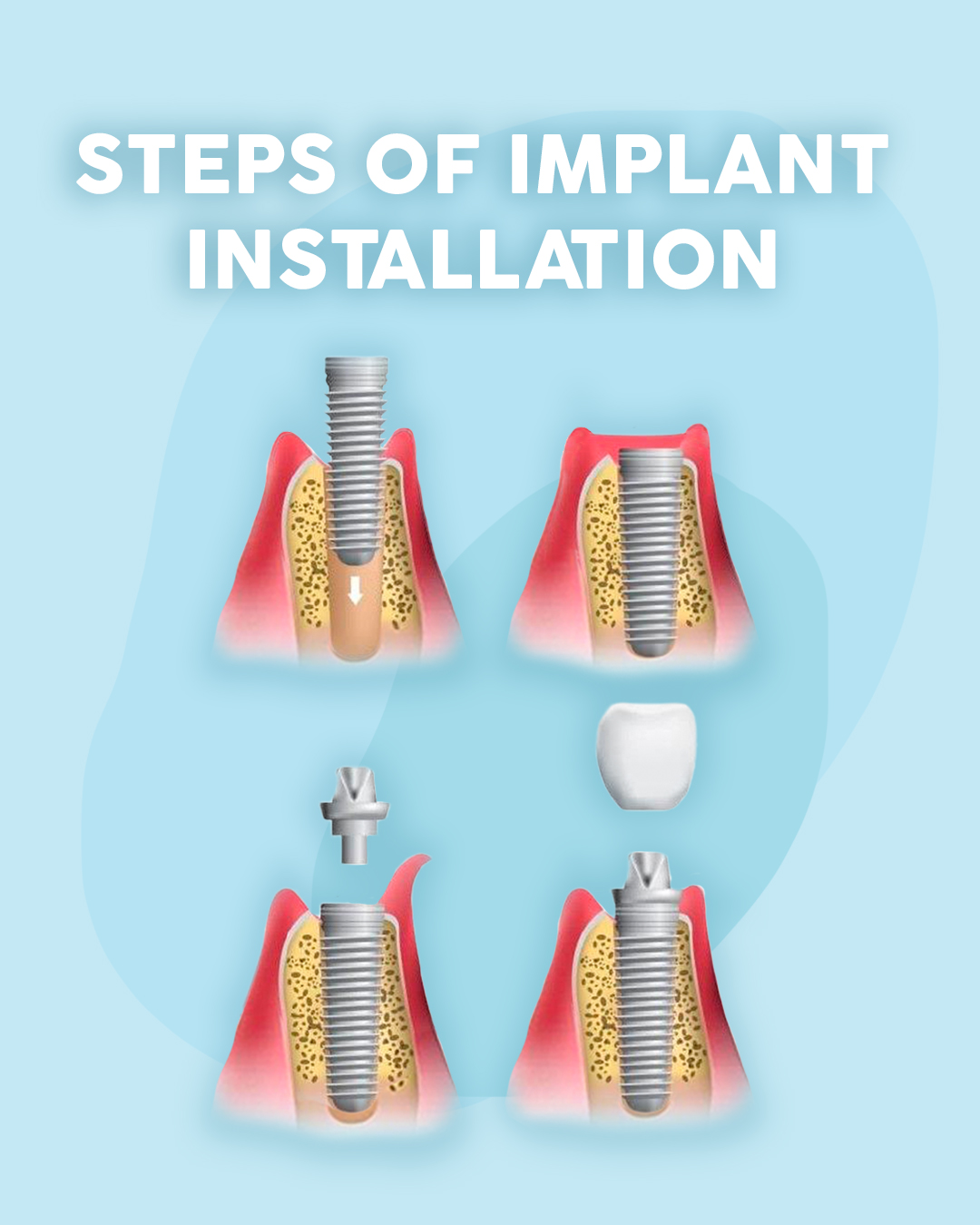 Art - Steps of dental implant installation ⠀ 1️⃣ Consultation and ...