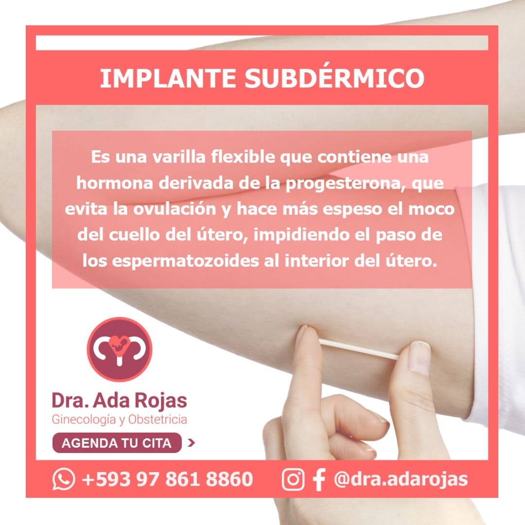 Dra. Ada Rojas - Implante Subdérmico es un Método...