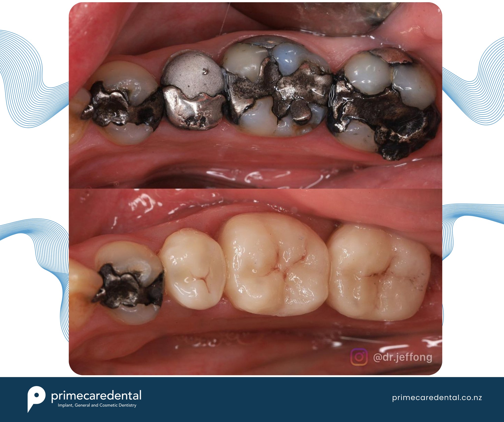 Primecare - 🦷 Understanding Large Fillings: The Wedge Effect 🌟 Did you ...