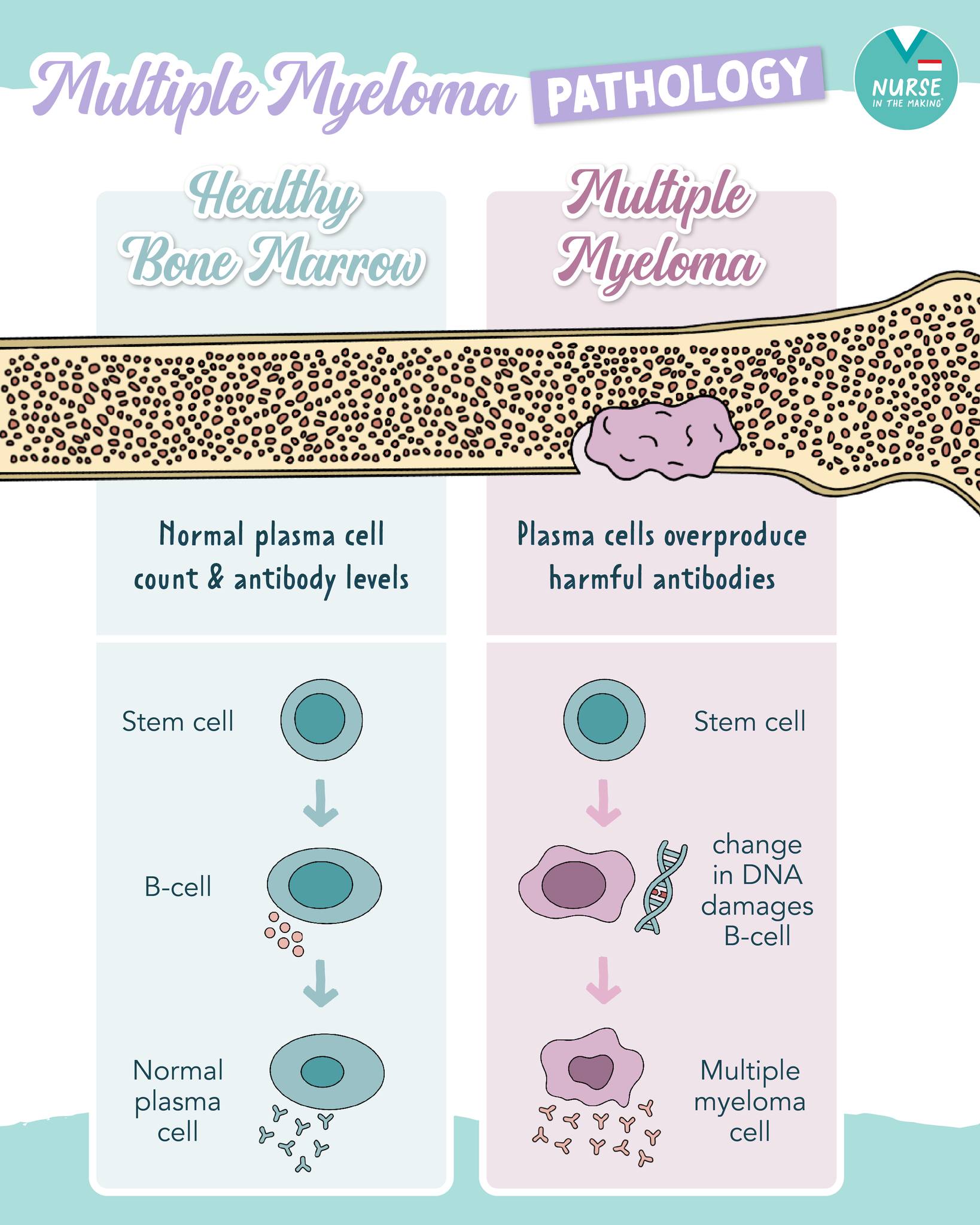 Multiple Myeloma Pathology🧬... - Nurse In The Making