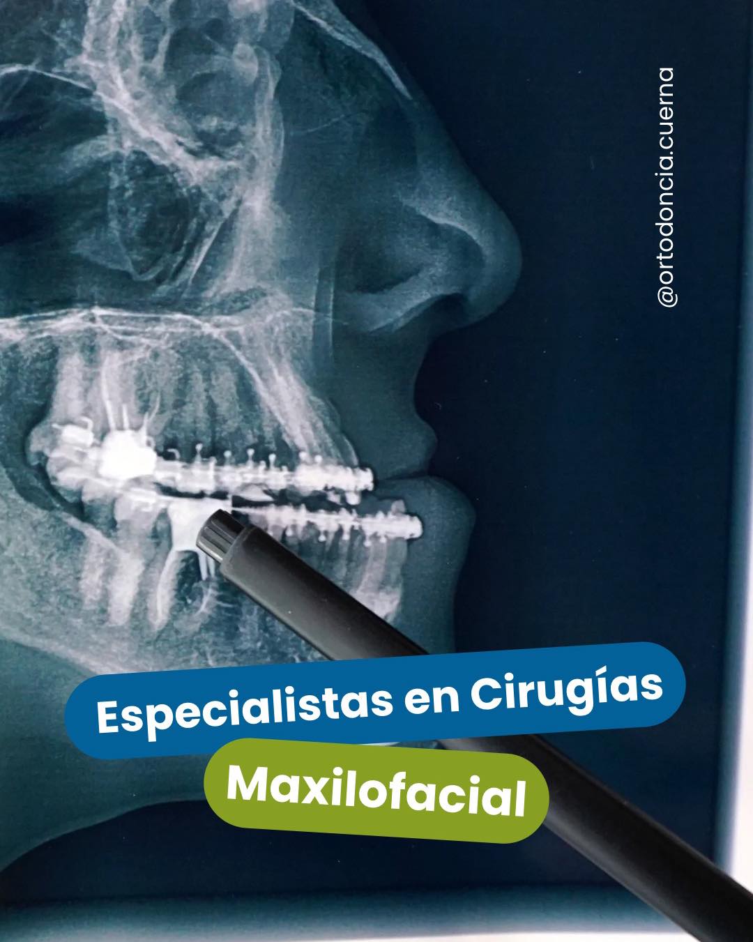 Ortodoncia SpaDental - Conoce Invisalign nuestra tecnología ...