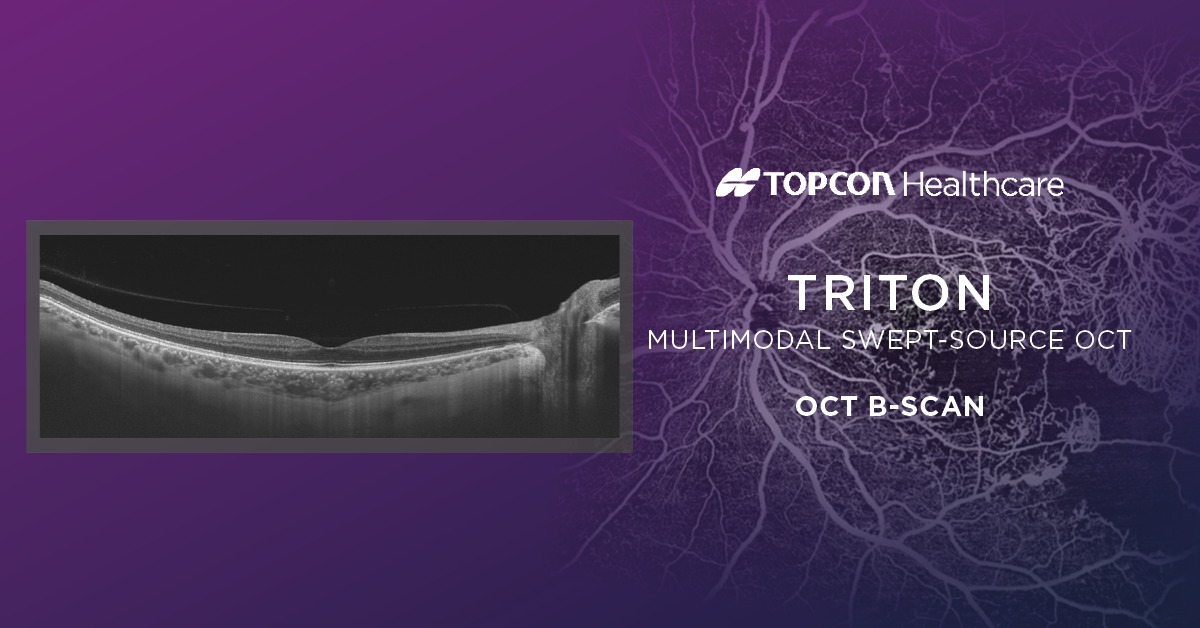 Topcon - NEW Wide Field OCT and OCT-A, from Triton The new optional ...
