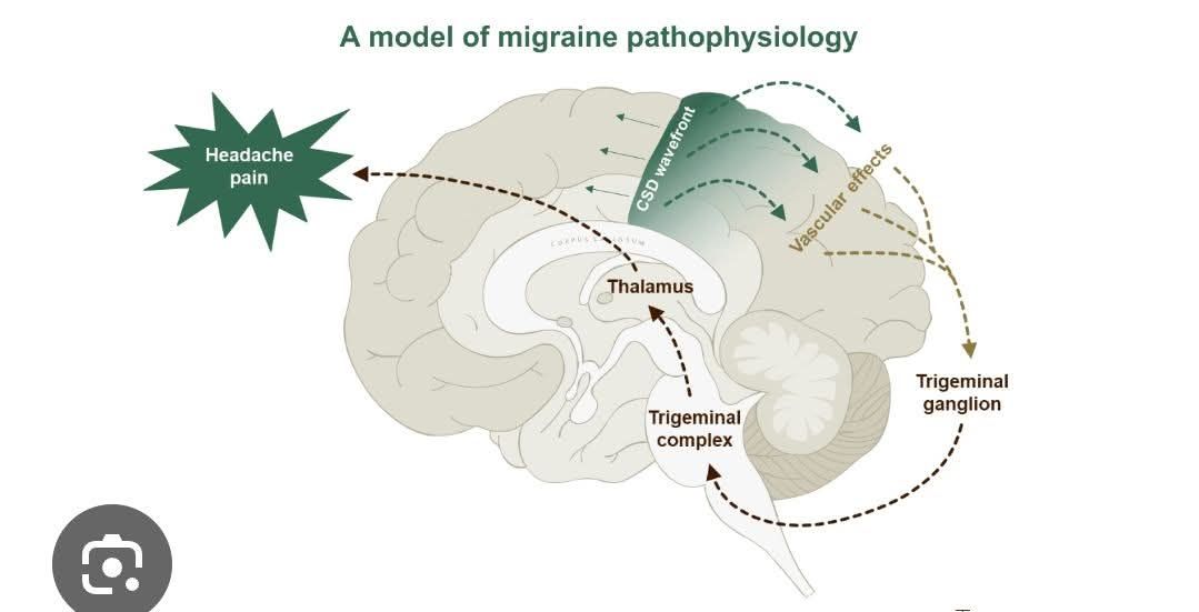 Anatomy - Pathophysiology of Migraine (High-Yield) Migraine is now ...