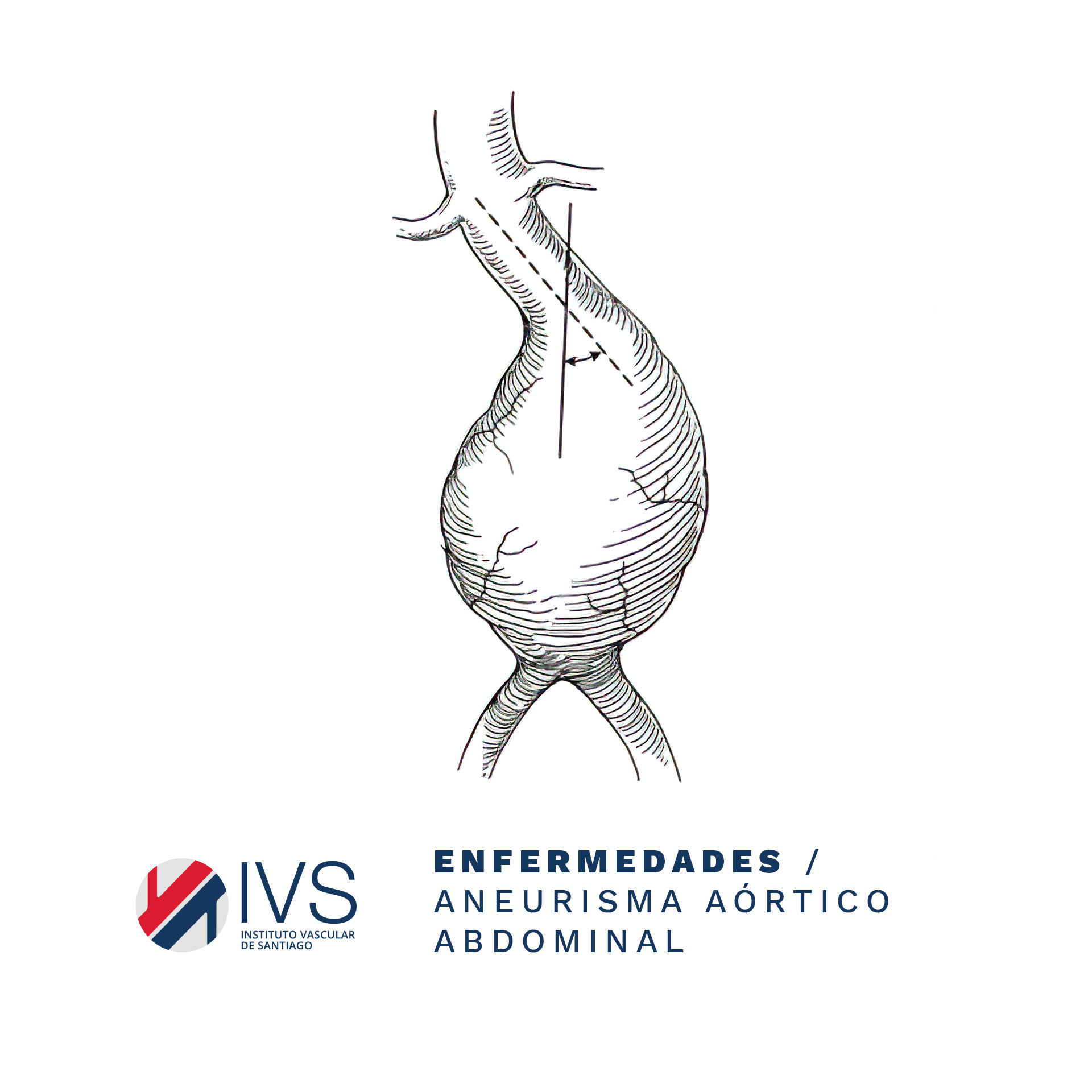 Instituto - ENFERMEDADES / Aneurisma Aórtico Abdominal Es la dilatación ...