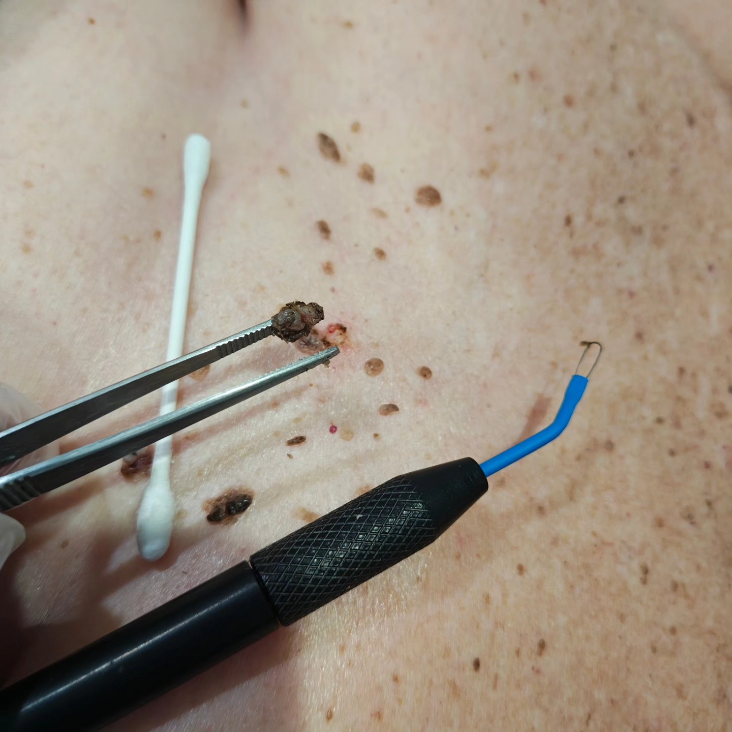 Aesthetic - Seborrhoeic keratosis (often called seb-K for short) is one ...