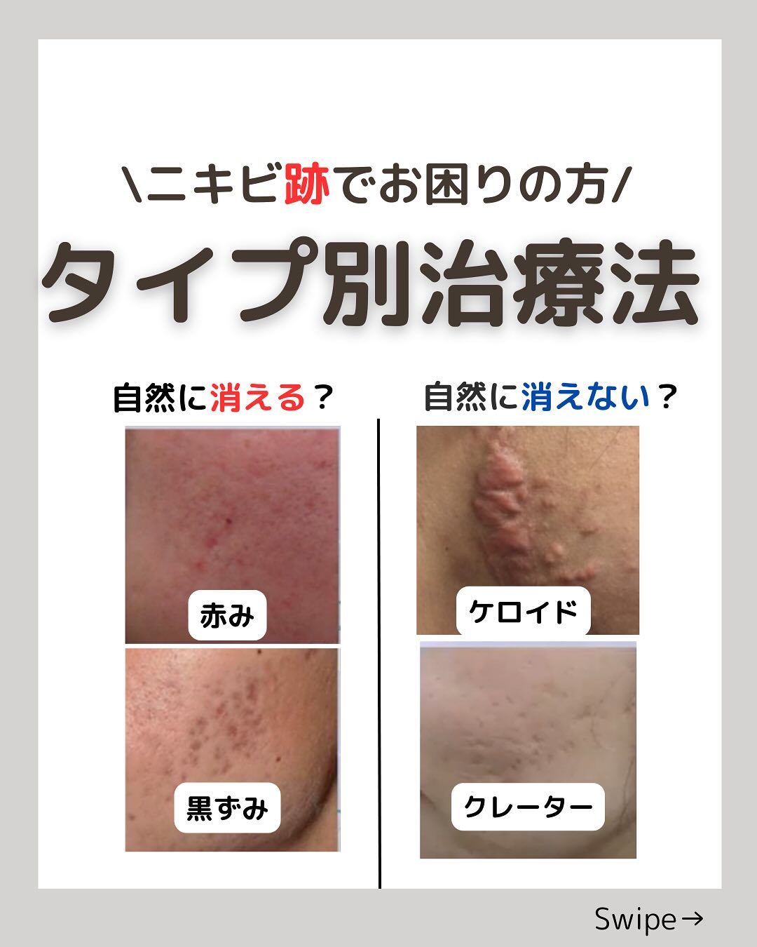 ニキビ 跡 消え ない