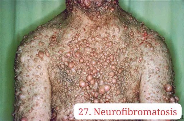 neurofibromotosis glutathione Current treatments for neurofibromatosis skin bumps A Comprehensive Guide to Size:2 Month Supply كريم مخصص للهالات