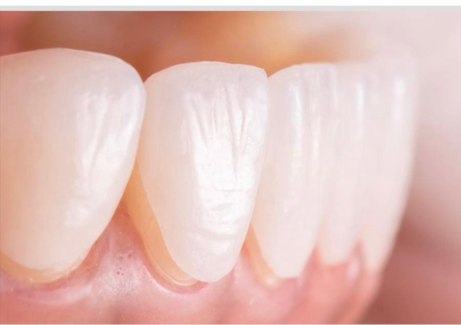 Nhổ Răng Khôn Làm Răng Số 7 Lung Lay - Nha Khoa Duy Hưng - RĂNG SỨ ...