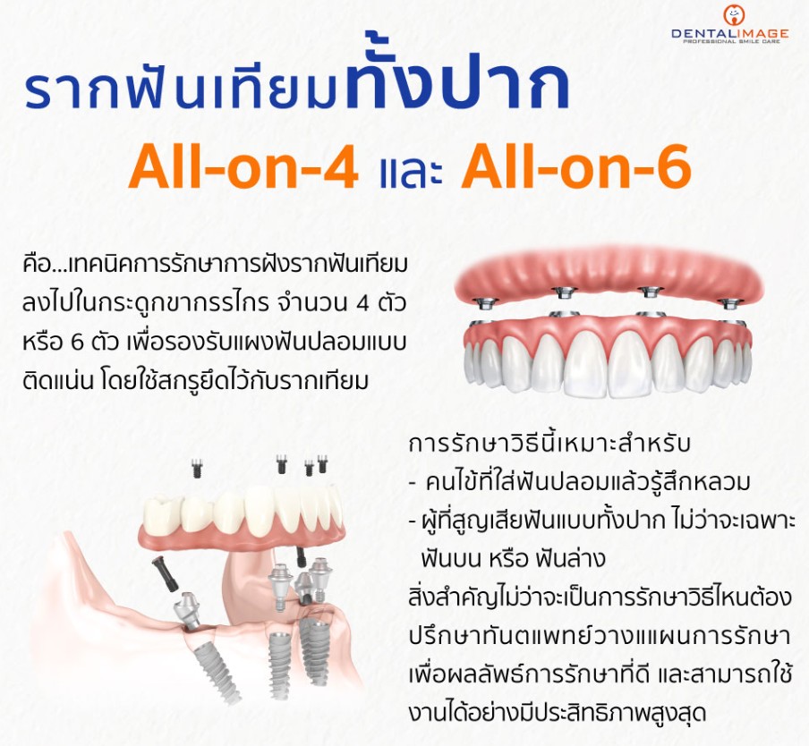 Dental Image สาขารามอินทรา - รากฟันเทียมทั้งปาก All-on-4 และ All-on-6 ...