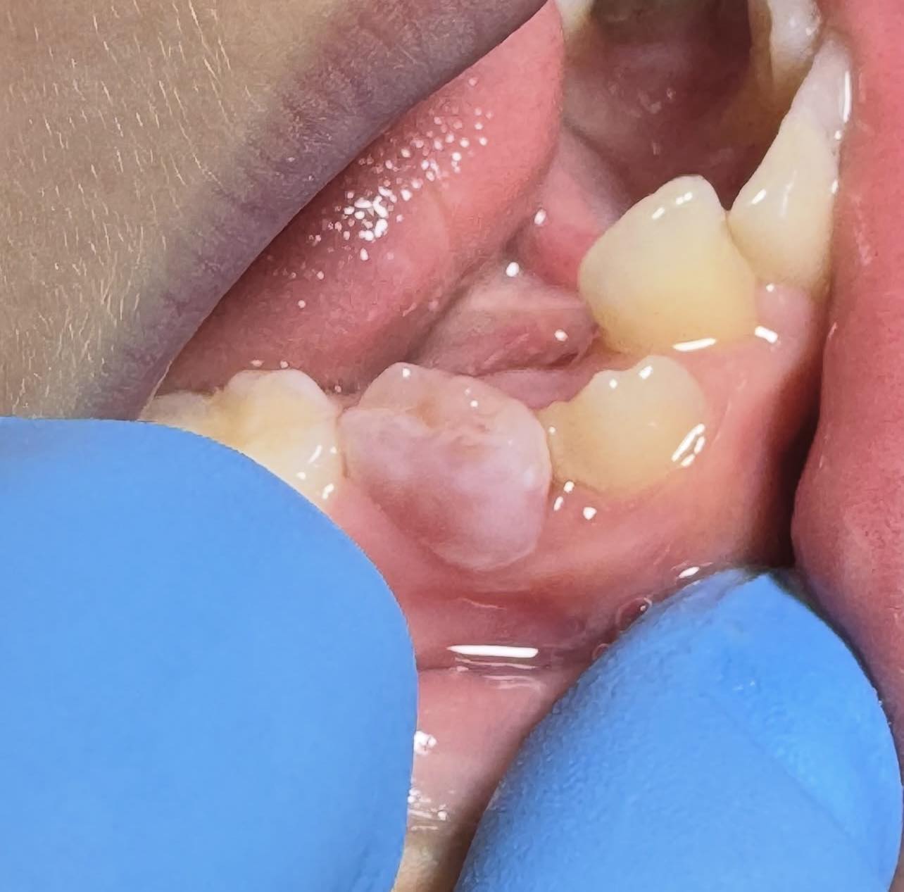 Diente rosado de Mummery 🦷 es una... - Odontología con Cri | Facebook