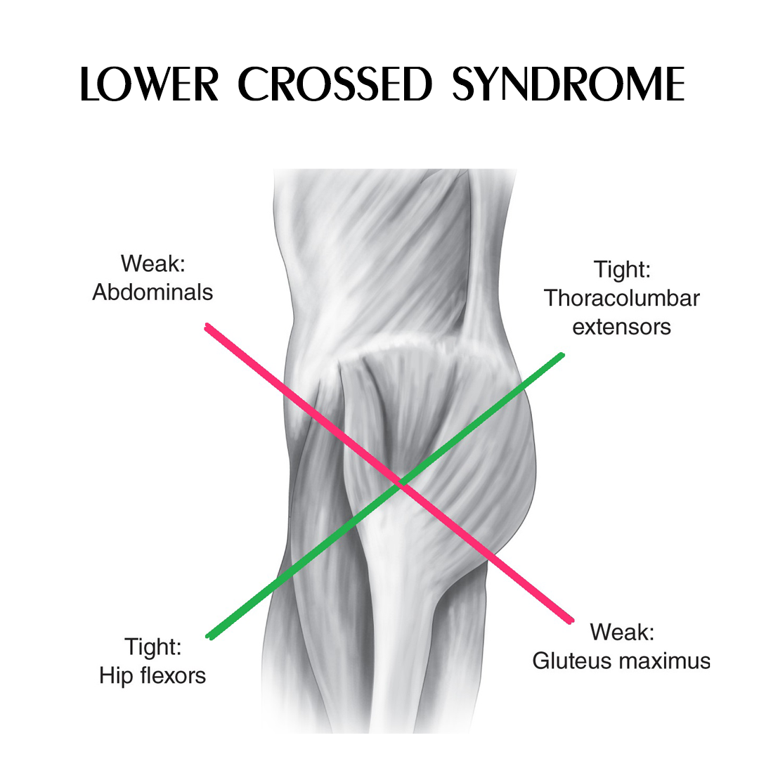 Healthy Street - LOWER-CROSSED SYNDROME Lower-Crossed Syndrome (LCS) is ...