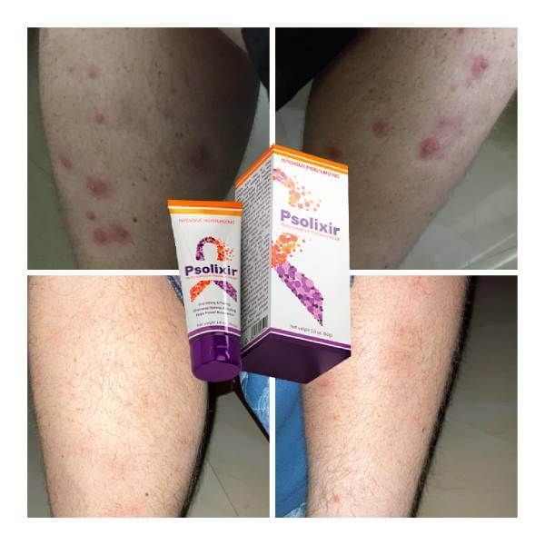 Psolixir Cream - India added a... - Psolixir Cream - India
