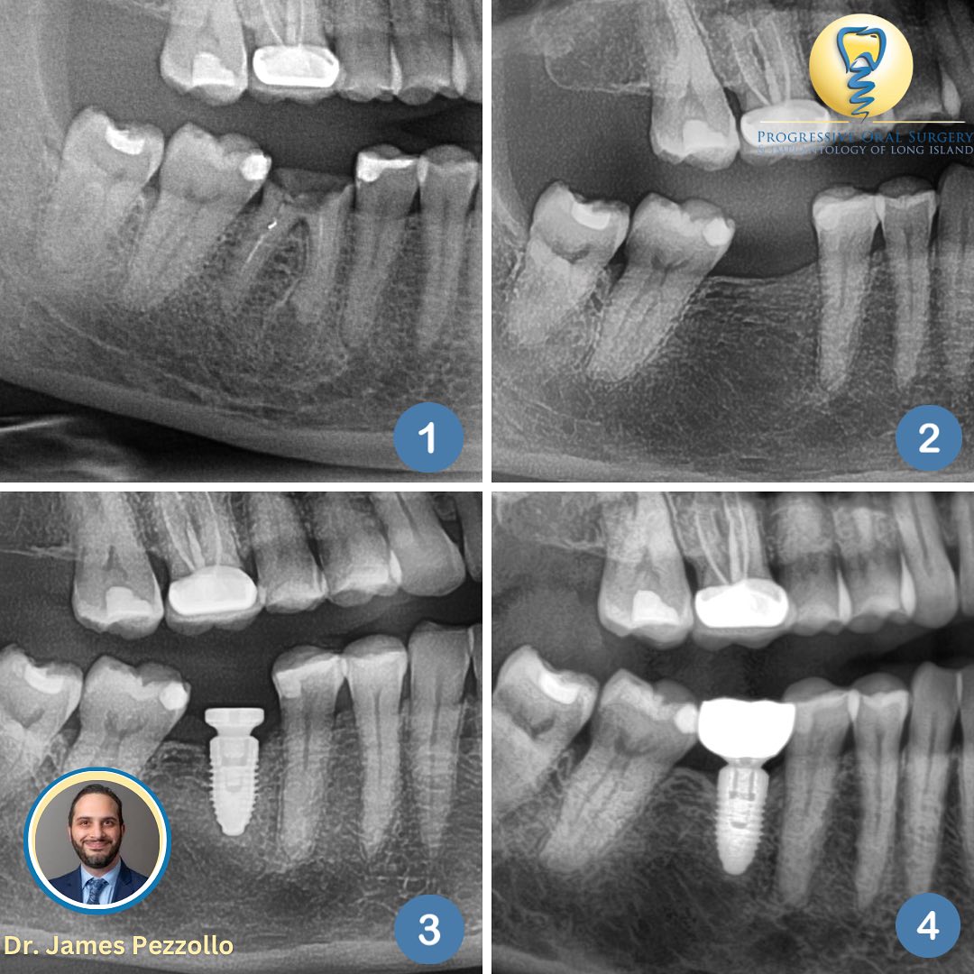 Progressive - 🦷 The Journey of a Smile Restoration 🦷 Take a look at the ...