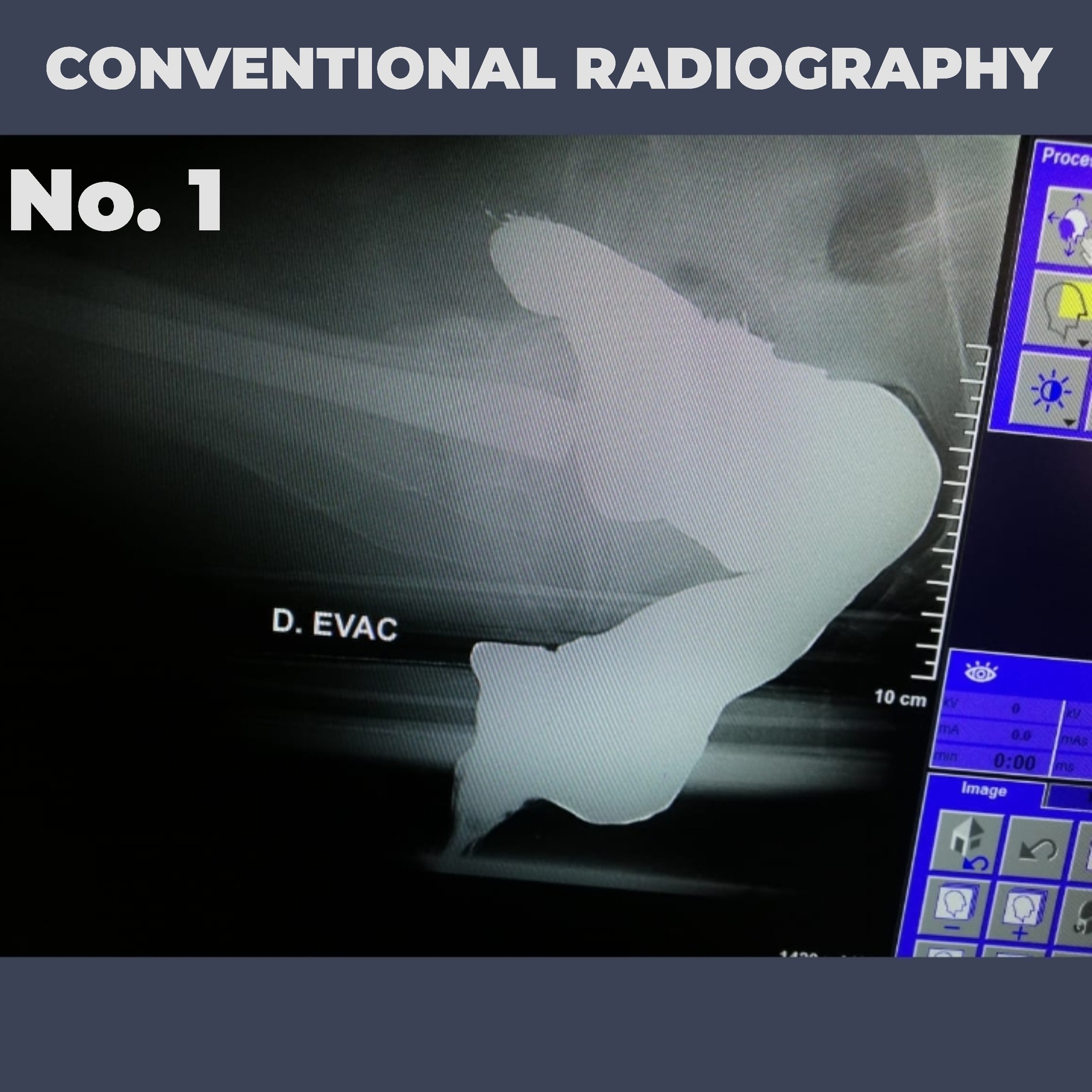 Conventional Radiography
