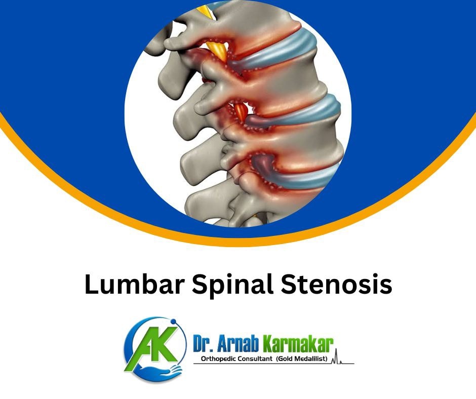 Complete - Lumbar spinal stenosis is a narrowing of the spinal canal ...