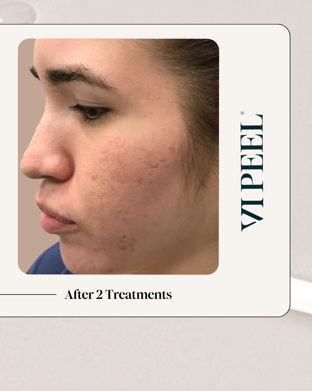 Greenville Dermatology - Whether on the beach, at the pool, or on the ...