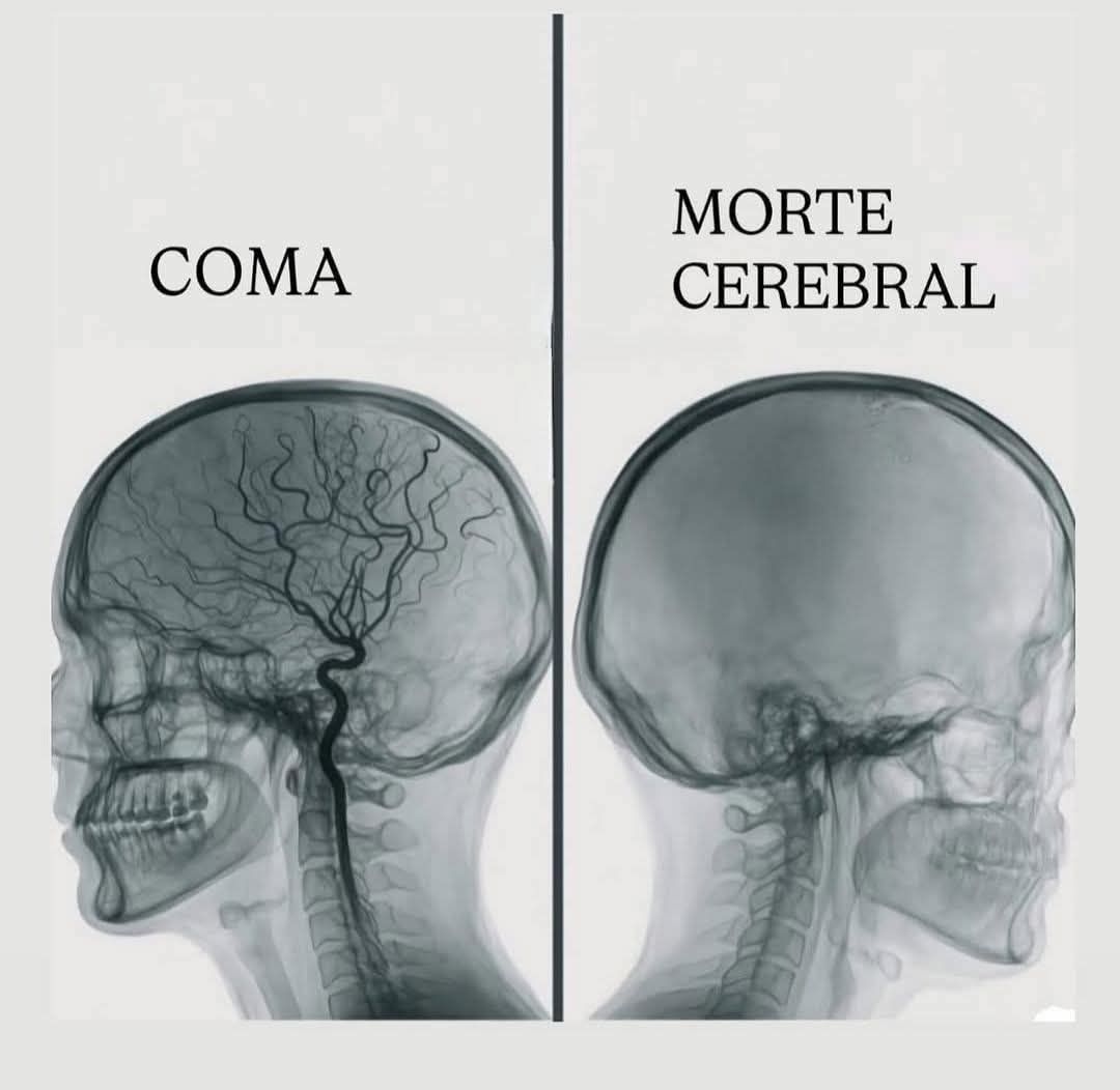 Ciência - O LIMITE DA VIDA: ENTENDA A DIFERENÇA IRREVERSÍVEL ENTRE COMA ...