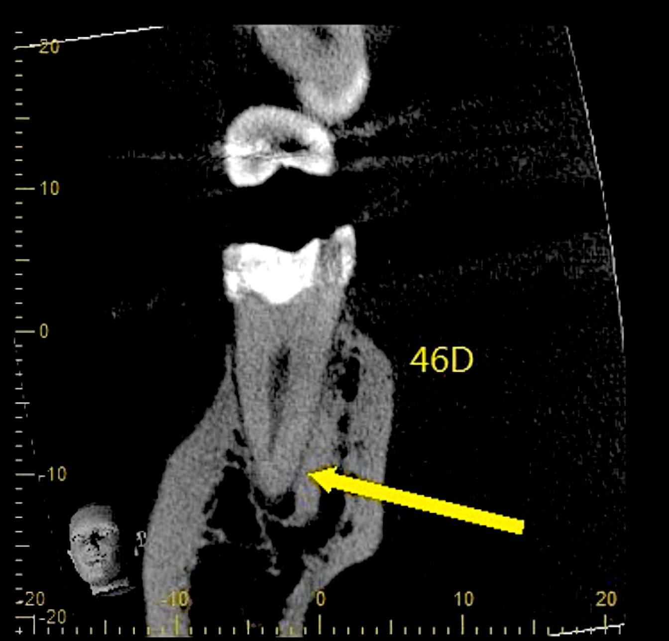 An endodontic fast break on a... - Pierre Pizem Endodontics | Facebook