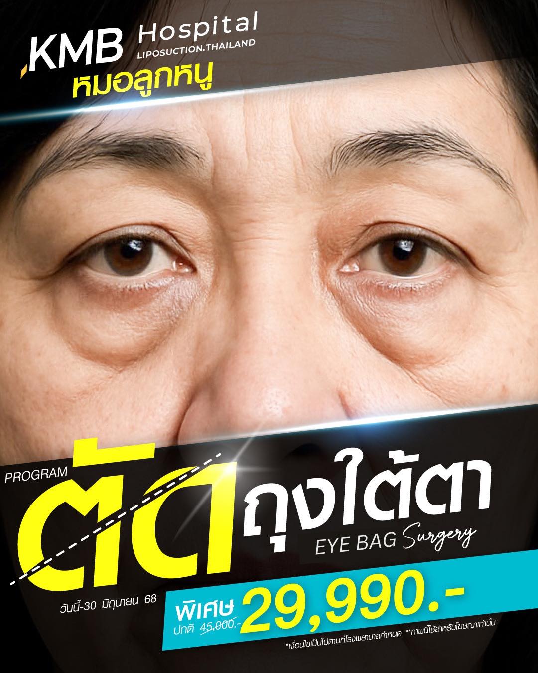 KMB - ไขมันใต้ตาเยอะ!! ต้องวิธีนี้ 👁️ บอกลาใต้ตาป่อง ปรับลุคให้ดูสดใส ...