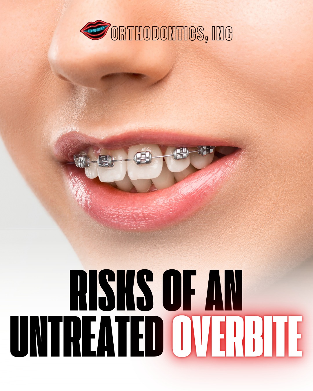 Orthodontics - Let’s talk about why it’s important to treat an overbite ...