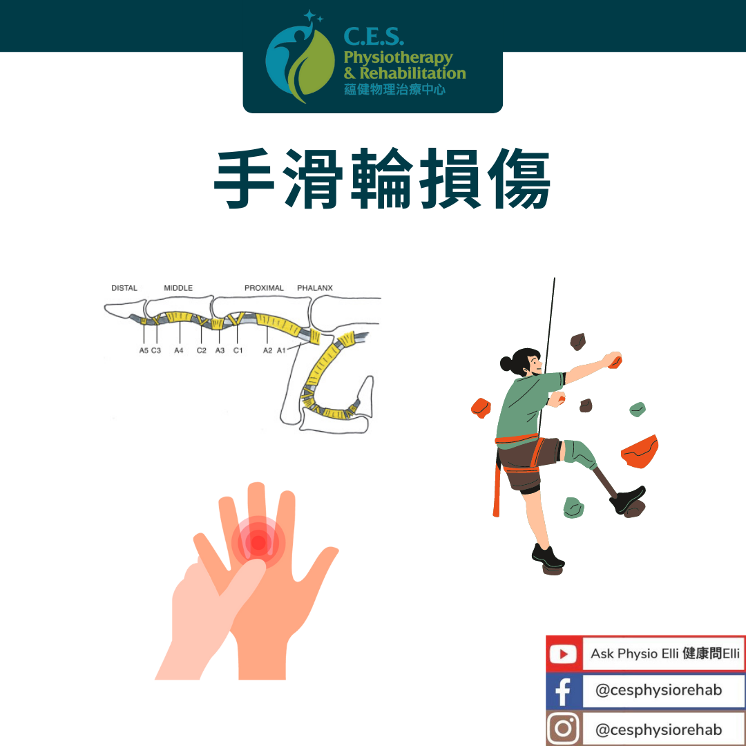 手滑輪是肌腱鞘的增厚區域，可為手的運動（... - C.E.S Physiotherapy & Rehabilitation