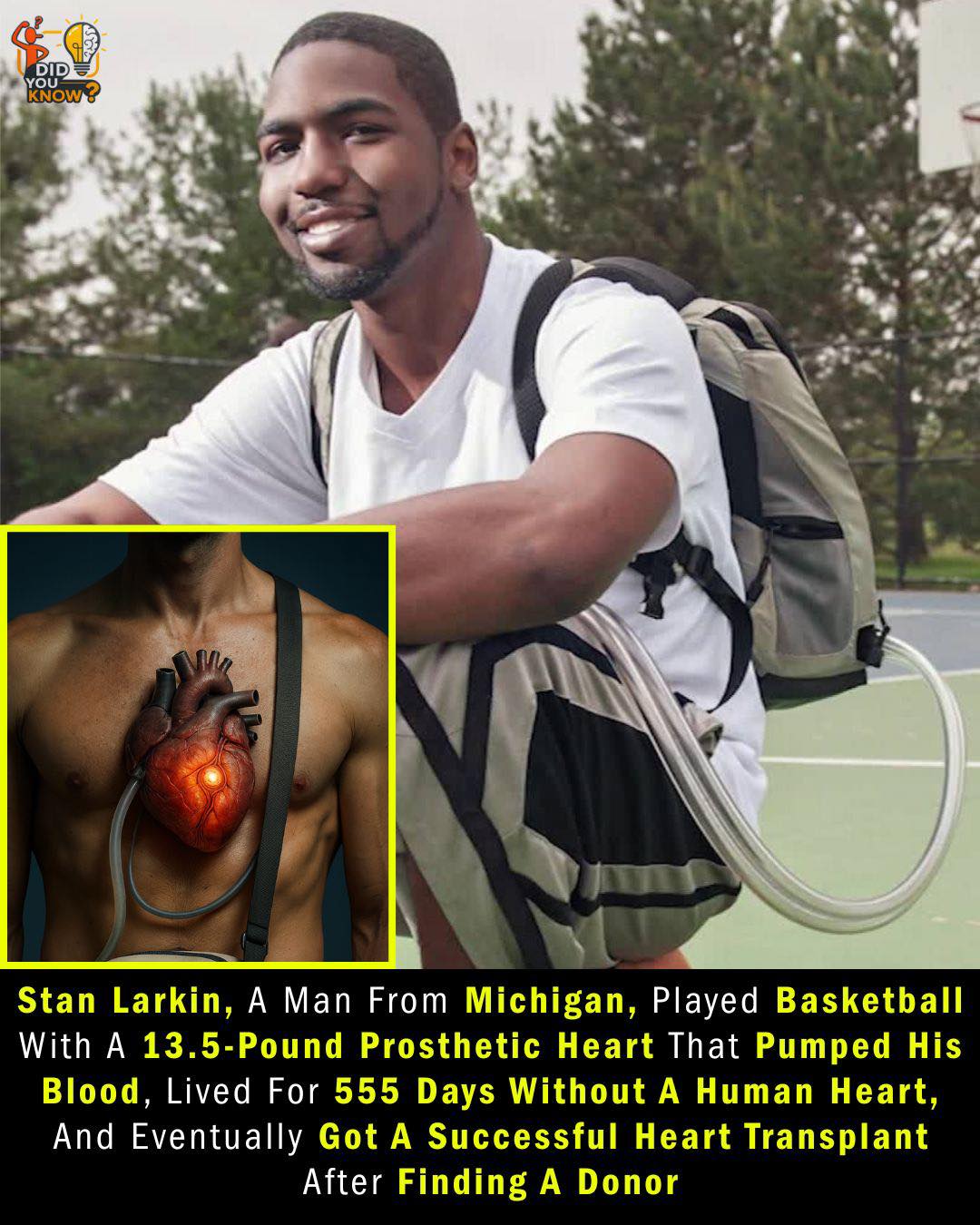 Did - The Man Who Lived Without a Heart ️🩺 In Michigan, 25-year-old ...