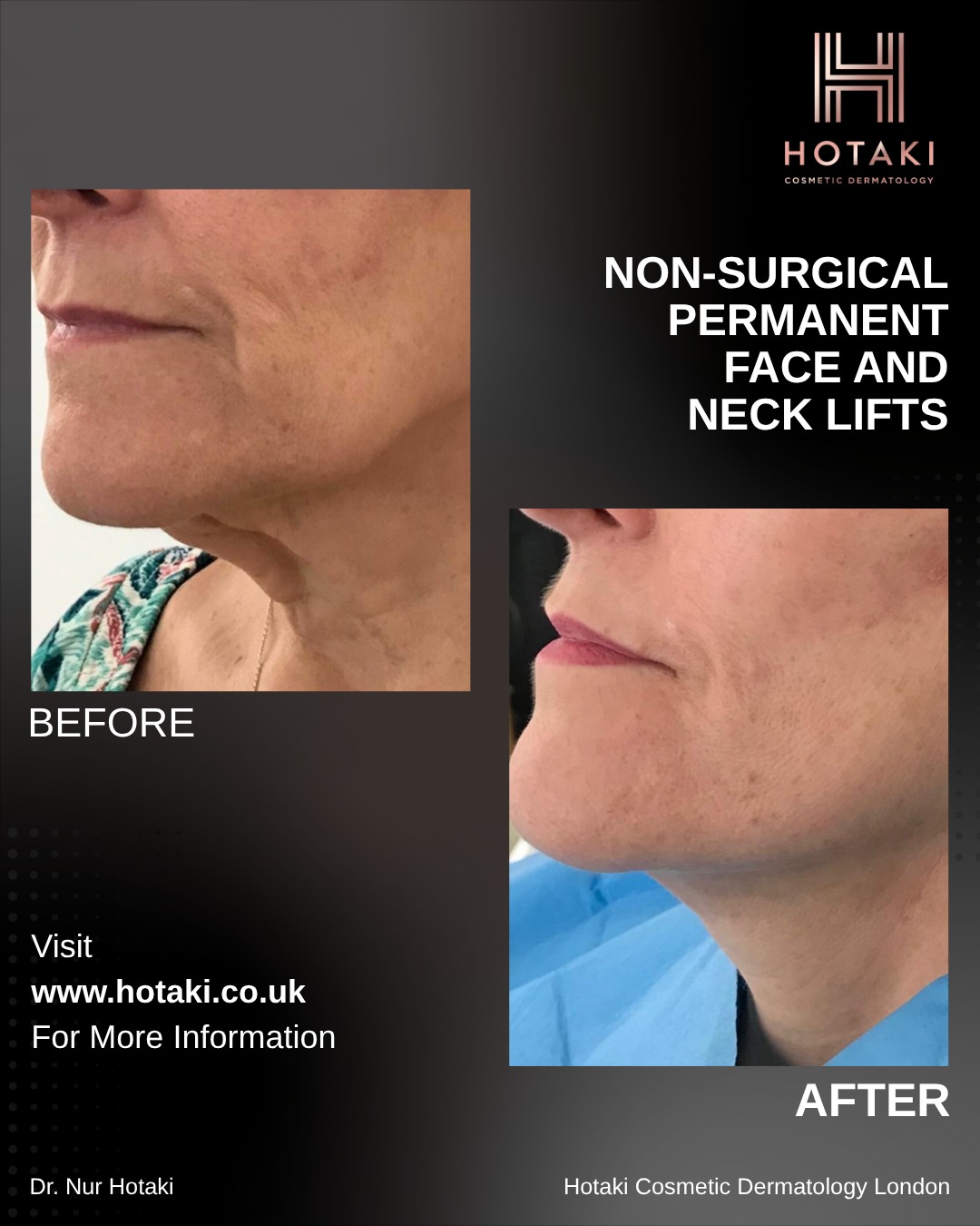 Hotaki - #DrHotaki #HotakiLondon #NonSurgicalAesthetics # ...