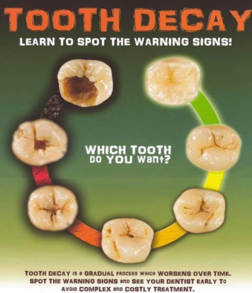 Lucañas Dental Clinic - Do you know the signs of a tooth decay ...