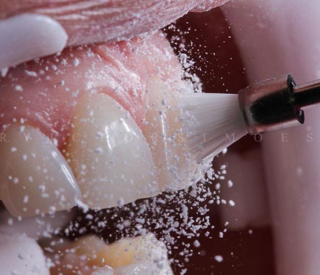 OdontoMap - 💠 La profilaxis dental: Un procedimiento sencillo que puede ...