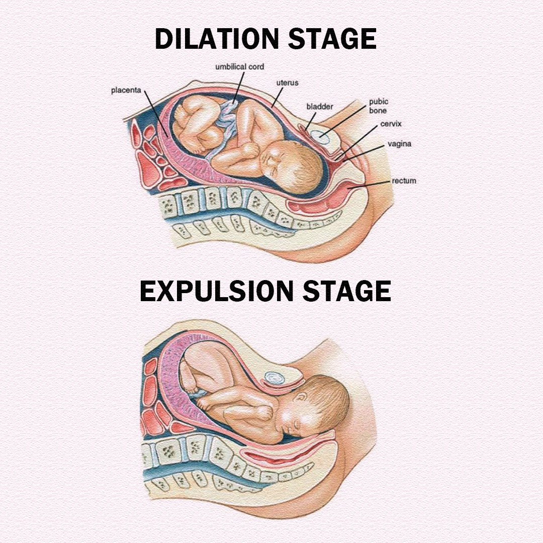 Pregnancy - 🌸 DILATION & EXPULSION STAGE 🌸 👶 Dilation Stage – Cervix ...