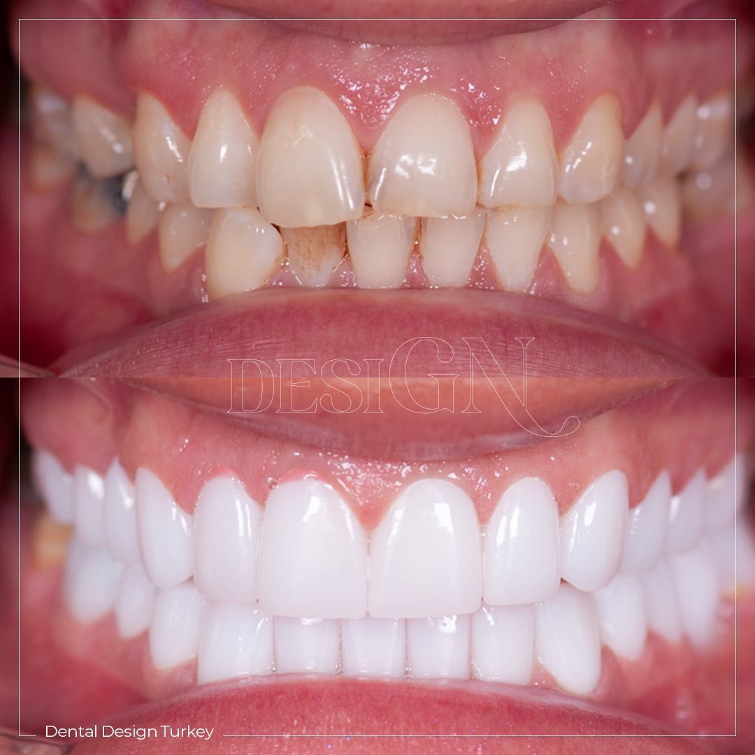 The power of smile with some... Dental Design Turkey