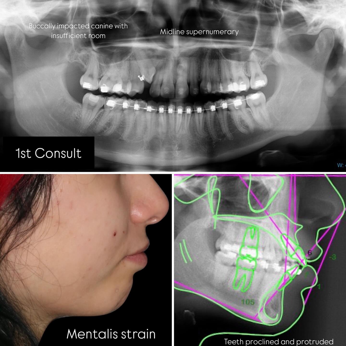 James Andrews Orthodontics - CLAW and Utility arch used in combination ...