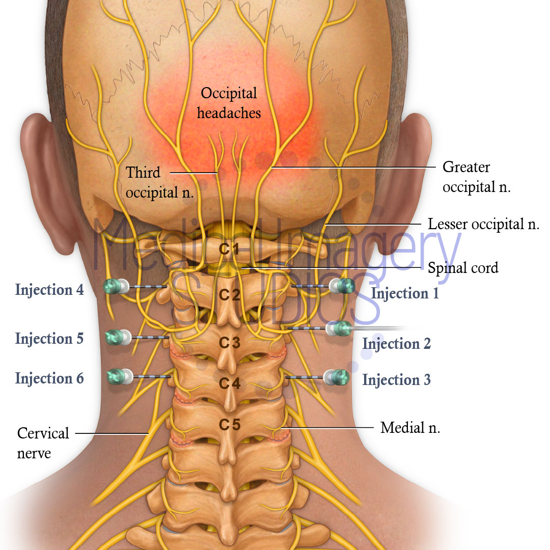 Medical - Cervical nerves pain injections sites | Facebook