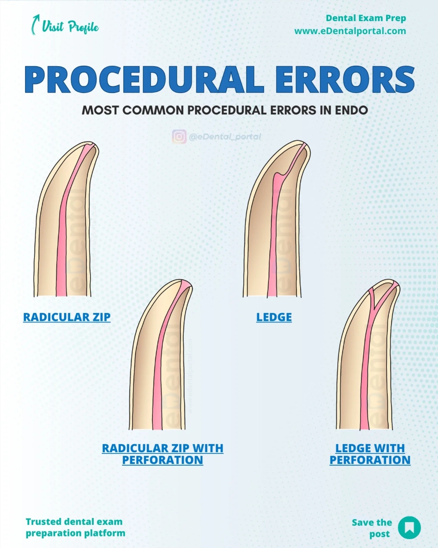 EDental Portal - 🦷 Common Procedural Errors in... | Facebook