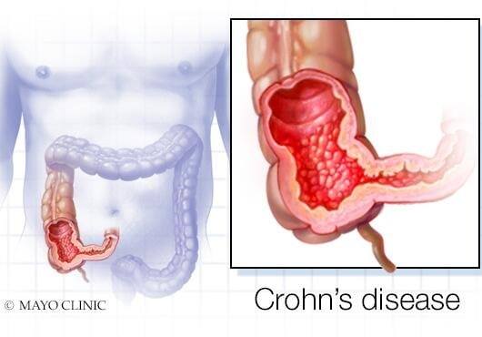 Patients with stable inflammatory bowel disease (IBD) and comorbid obesity and/or diabetes who started GLP-1 receptor agonists (semaglutide or tirzepatide) alongside ongoing treatment did not have a lower risk for the relapse