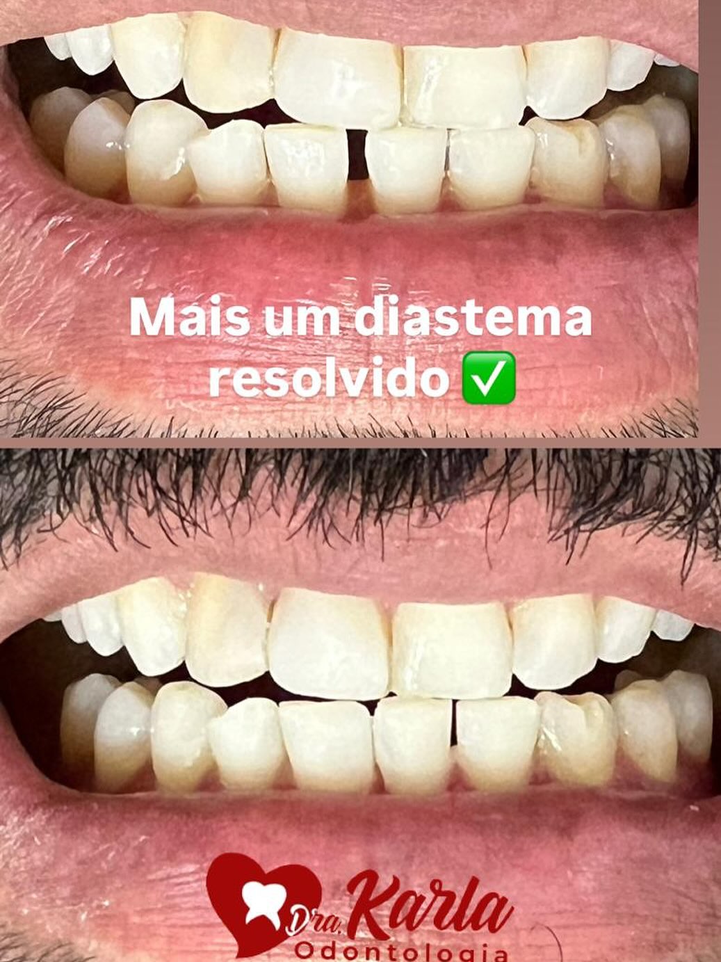 Dra. Karla Odontologia - Dente com toda face vestibular cariada ...