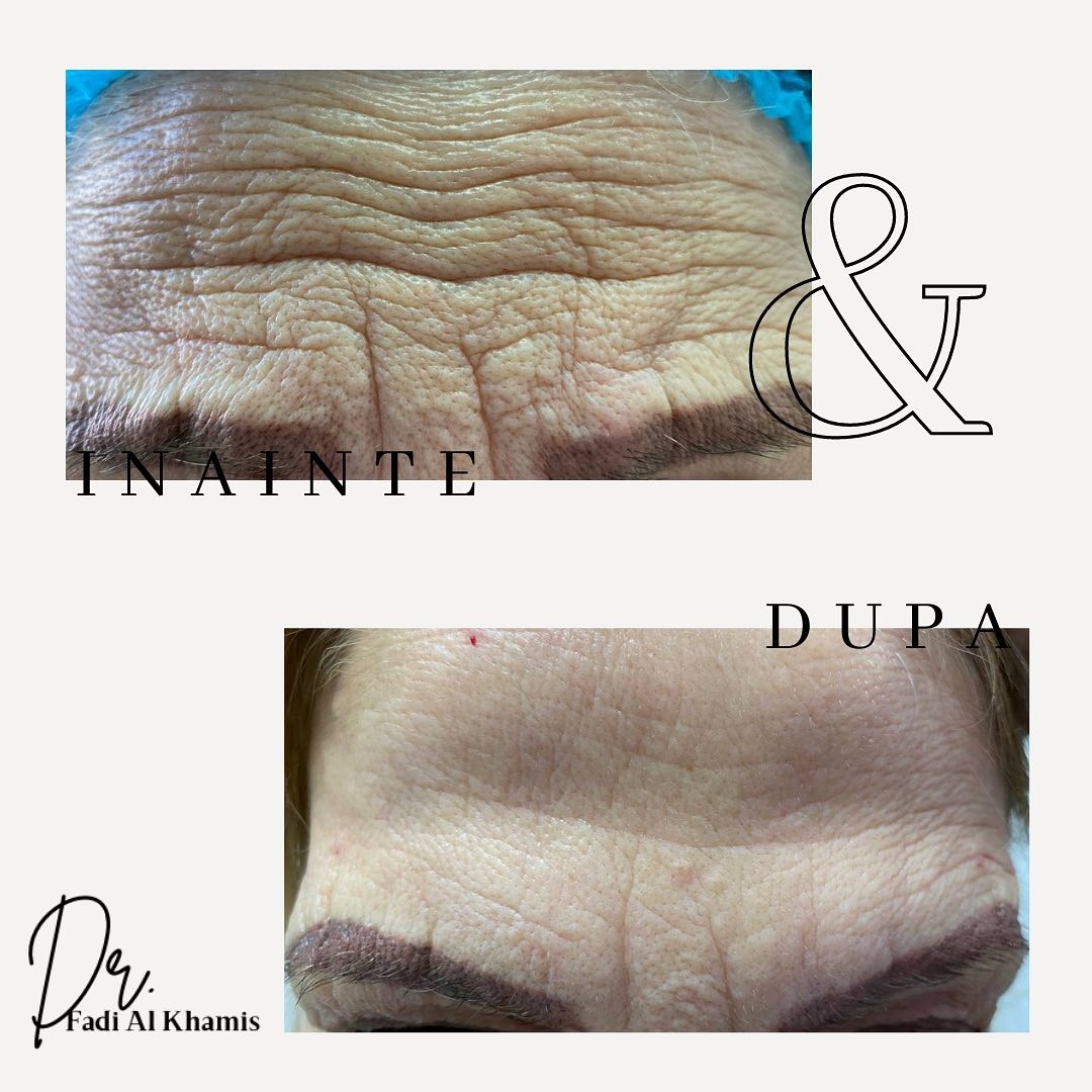 Tratamentul injectabil cu toxina... - Dr. Fadi Al Khamis