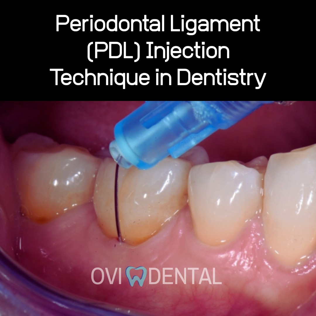 OVIdental Go - 🚫 Periodontal Ligament (PDL) Injection... | Facebook