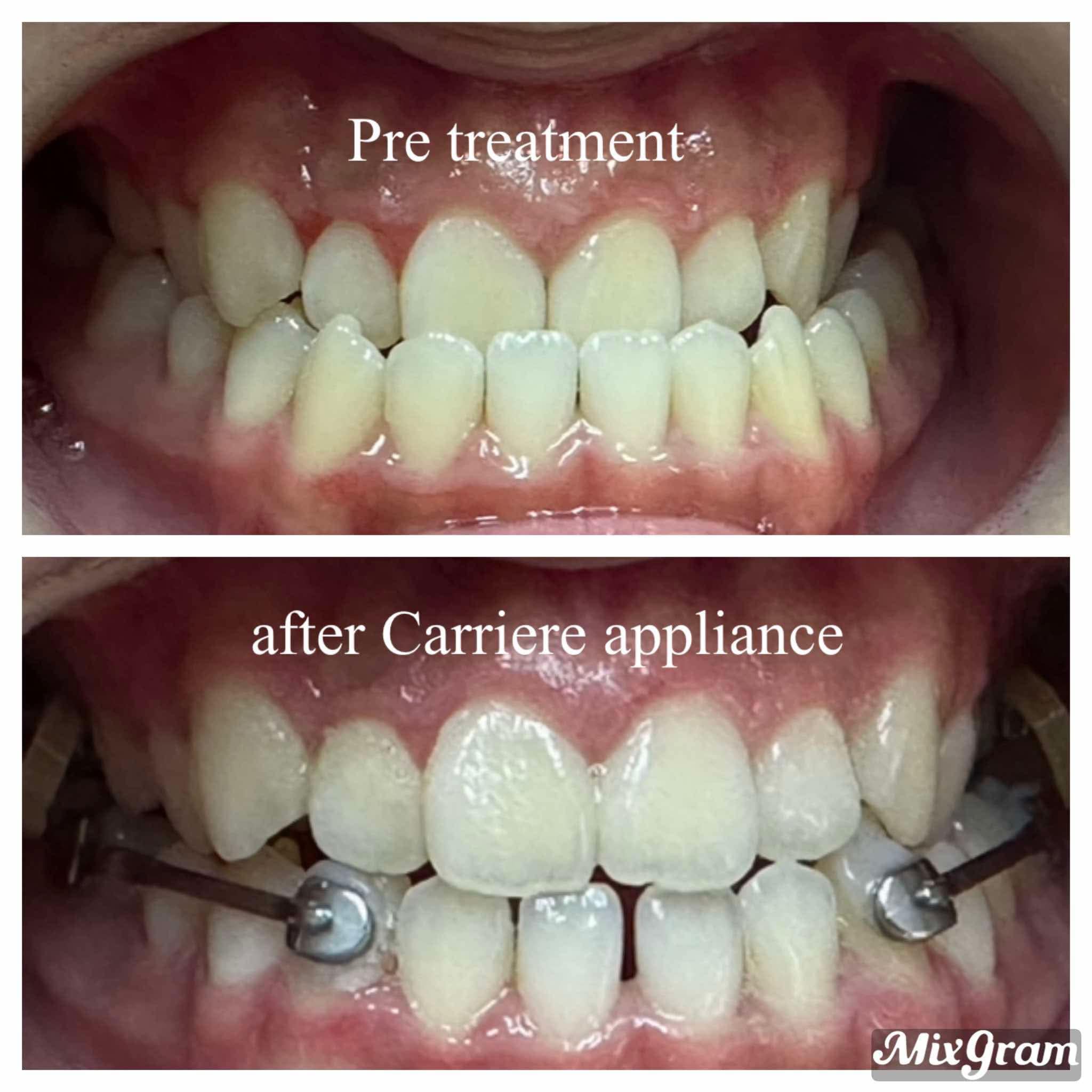Global Dental Clinic - We care for our teeth. After eating we either ...