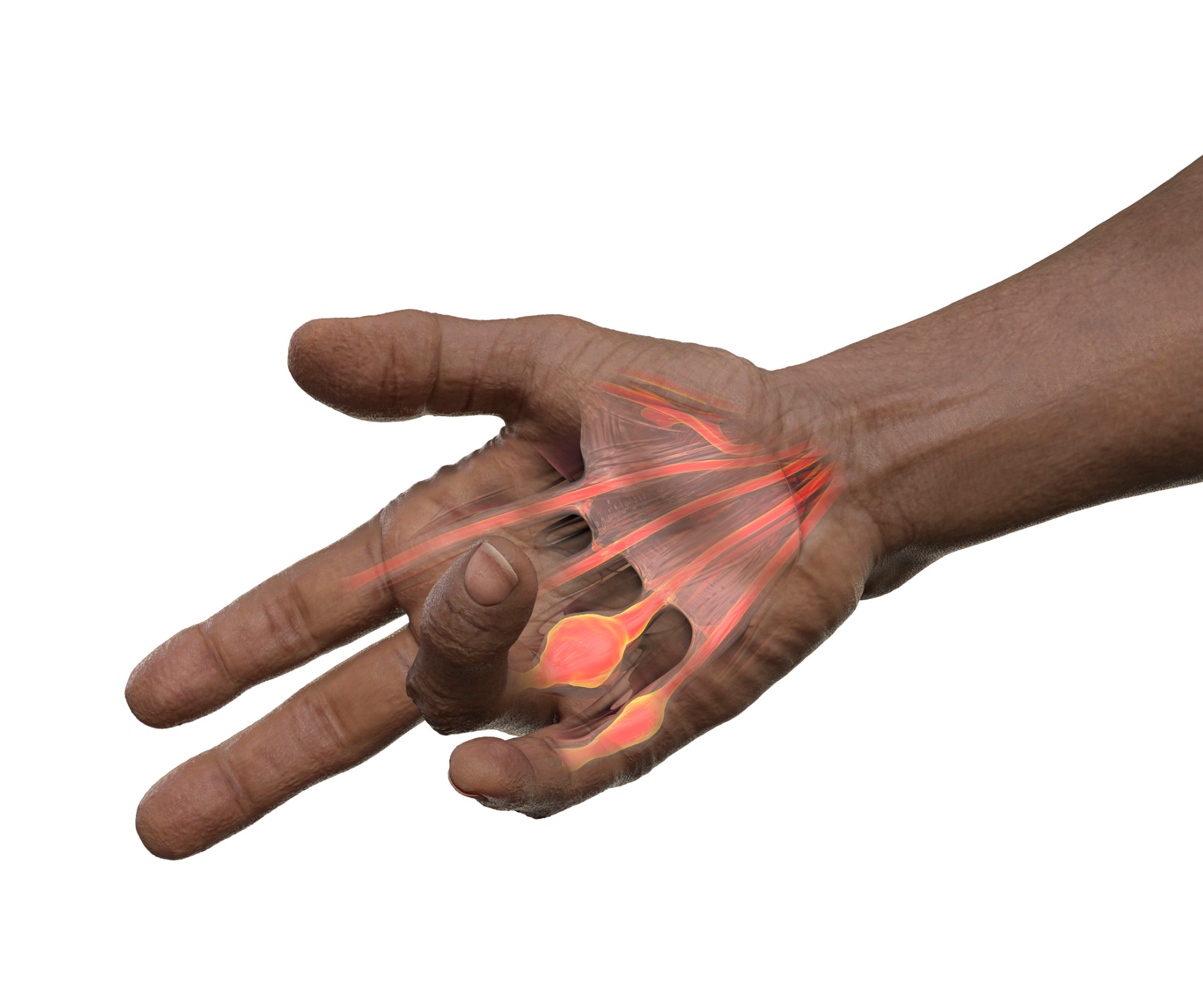 Rulli - Trigger finger, also known as stenosing tenosynovitis, is a ...