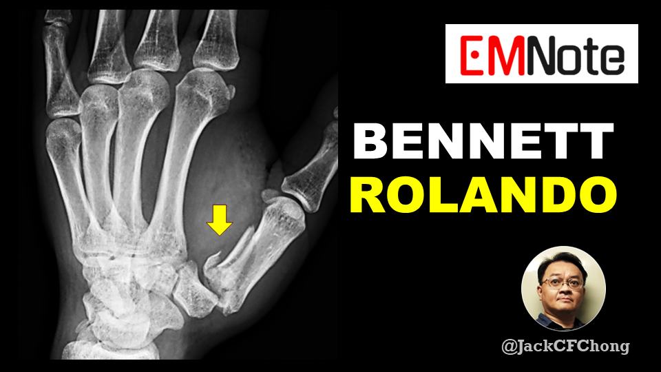 EMNote.org - Bennett and Rolando Fractures of the Thumb https://youtu ...