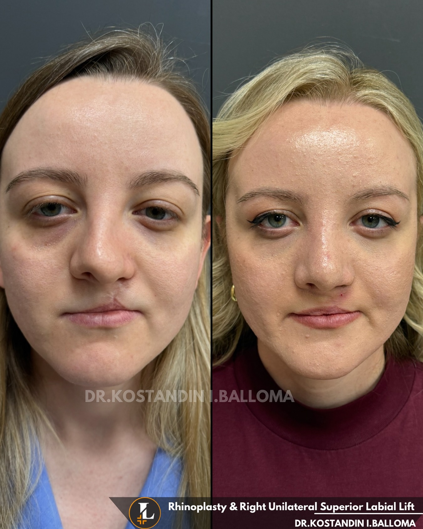 Combined Rhinoplasty & Lip... - Dr. Kostandin I. Balloma | Facebook