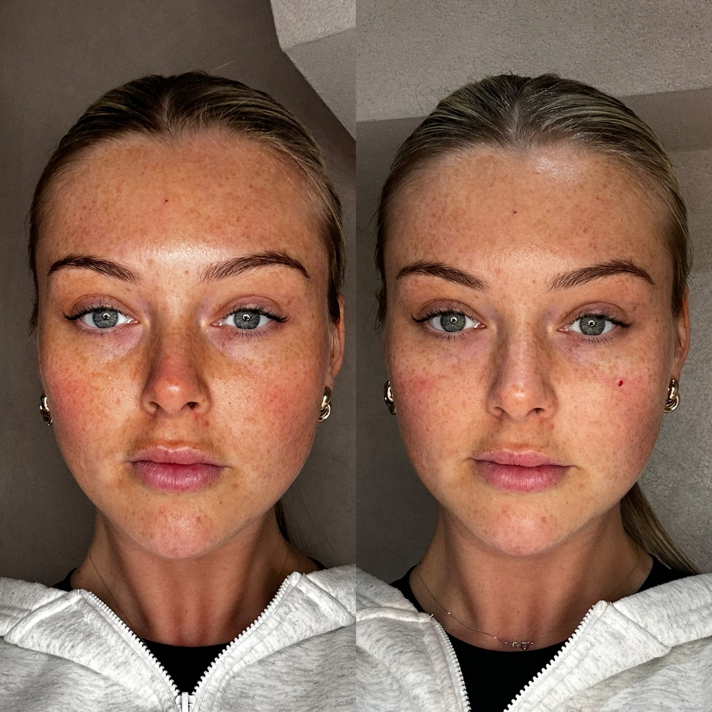 House - no edits no different lighting ☑️ just minimal tear trough ...