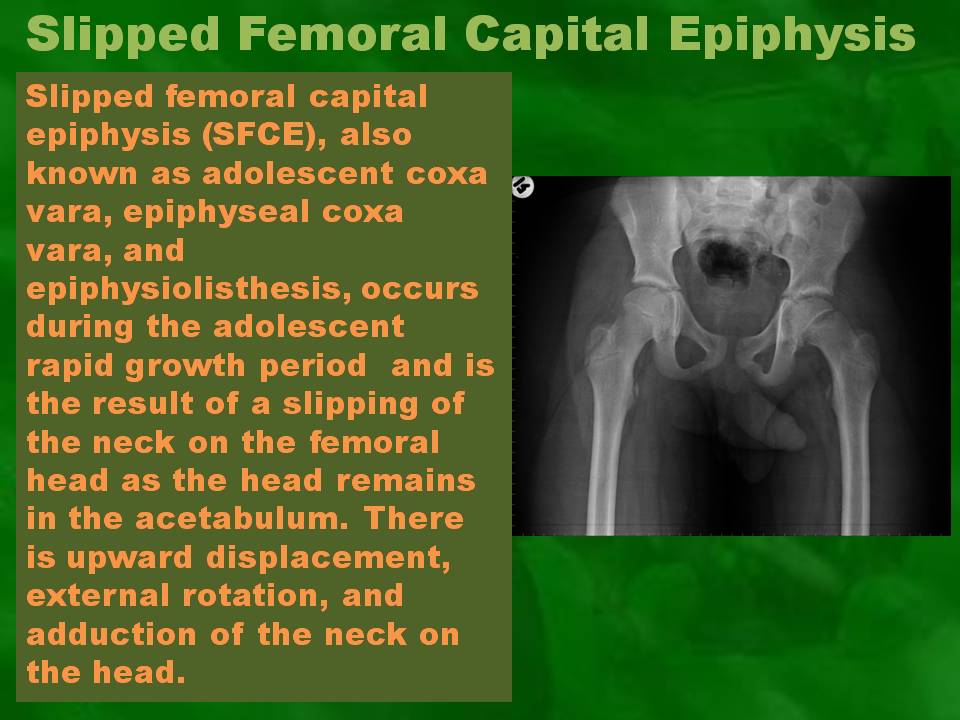 Slipped Capital Femoral Epiphysis Radiology Slipped Capital Femoral